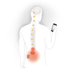 Spinal Cord Stimulation - Advanced Pain Consultants, P.A.