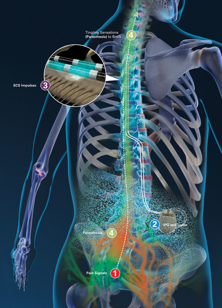 st judeabbott burst platform spinal cord stimulator
